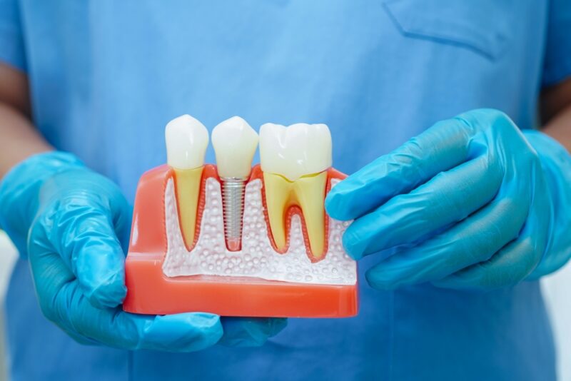 Dental Implants Evanston